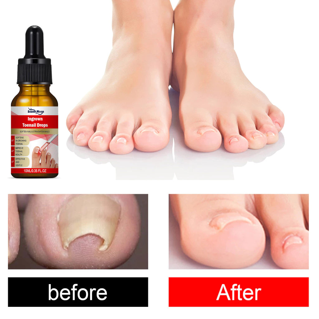 Ingrown Toenail Drops 60 ml Pack of 2